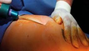 90 % من المترددين على مصحات التجميل فقراء و5000 حالة شفط للدهون تجري سنويا