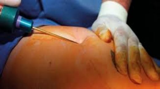 90 % من المترددين على مصحات التجميل فقراء و5000 حالة شفط للدهون تجري سنويا