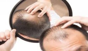 دراسة حديثة تظهر سر مكافحة الصلع