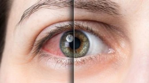 طرق وعلاجات منزلية للتخلص من جفاف وحكة العين.. تعرف عليها
