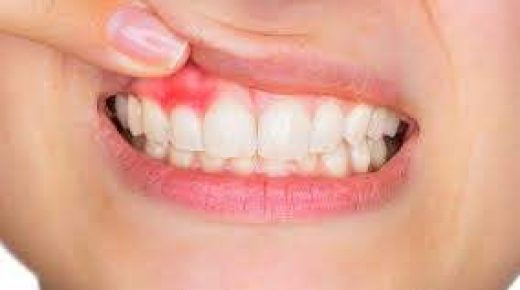 تعرف على أسباب ترسبات الأسنان وعنايتها بالعلاجات المنزلية وزيارة الطبيب مهمة
