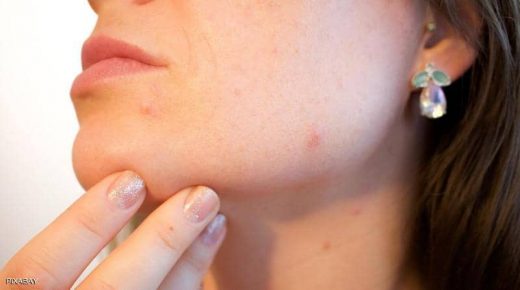 لبشرة خالية من حب الشباب.. تجنبوا تناول هذه الأطعمة