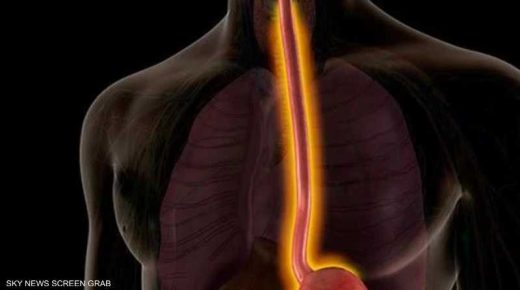 صعوبة في بلع الطعام تكرار الأمر قد يكون عارضا ينبه لمرض خبيث.
