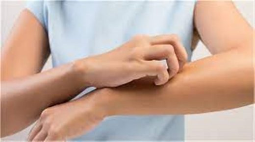 حكة الجلد: خطوات لأجل تخفيف الحكة