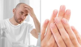 الرجال أكثر عرضة للإصابة بالصلع كلما كانت أصابعهم أطول من السبابة