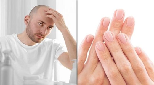 الرجال أكثر عرضة للإصابة بالصلع كلما كانت أصابعهم أطول من السبابة