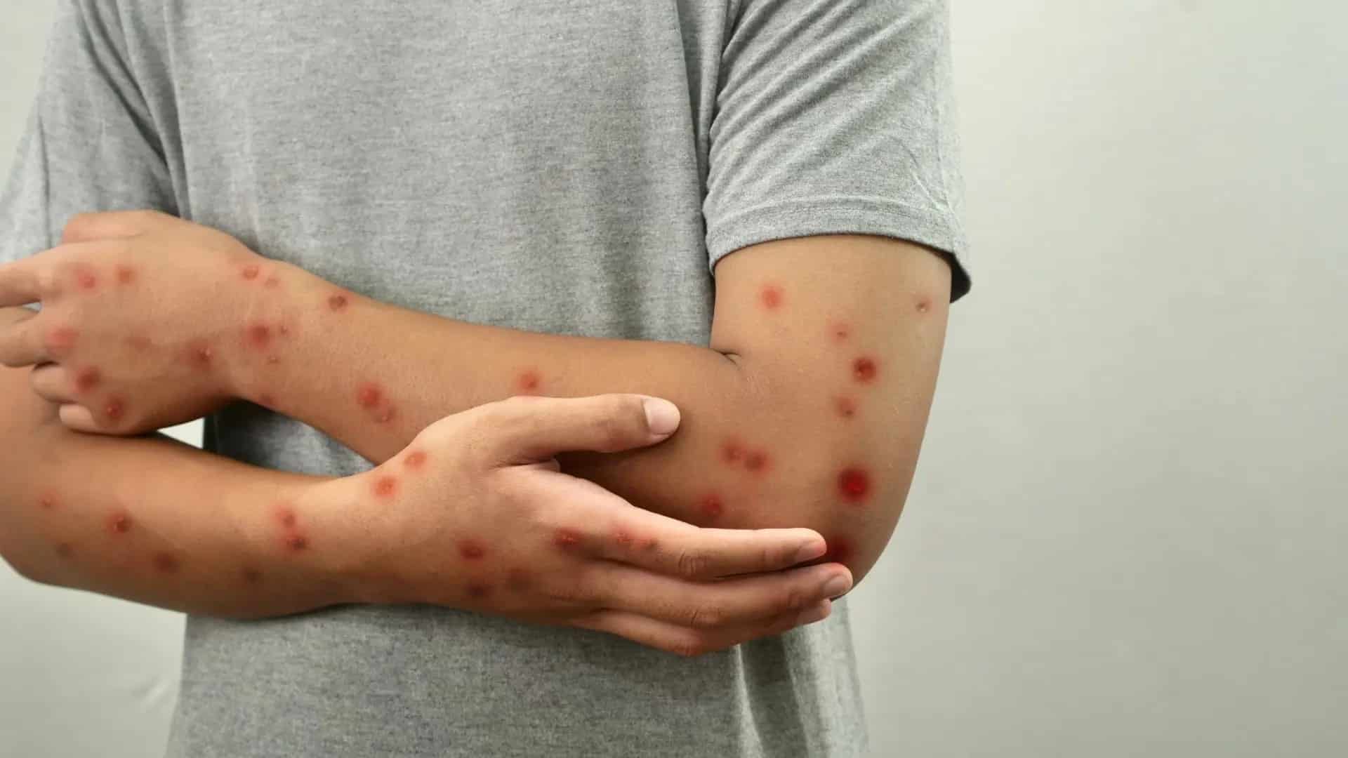 تفشي بوحمرون في السجون: 41 إصابة وسط النزلاء والمندوبية تتحرك